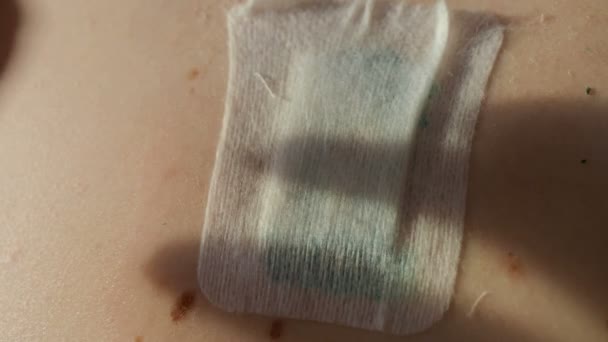 Peeling del parche en la cicatriz después de la eliminación de suturas quirúrgicas. Nevus grande ha sido extirpado quirúrgicamente con un bisturí. Medidas preventivas contra el cáncer de piel . — Vídeos de Stock