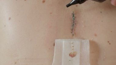 Cerrahi sütür ile yeşil çıkarıldıktan sonra yara kapsayan. Büyük nevus neşterle cerrahi olarak eksize. Cilt kanserine karşı önlem.
