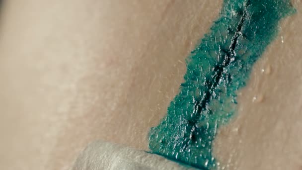 Covering scar after removal of surgical sutures with brilliant green . Large nevus has been excised surgically with a scalpel. Preventive measure against skin cancer. — Stock Video