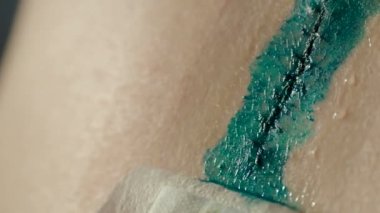 Cerrahi sütür ile yeşil çıkarıldıktan sonra yara kapsayan. Büyük nevus neşterle cerrahi olarak eksize. Cilt kanserine karşı önlem.