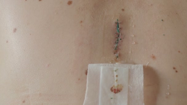 Close-up video van het litteken na verwijdering van chirurgische hechtingen. Groot nevus heeft operatief is weggesneden met een scalpel. Preventieve maatregel tegen huidkanker. — Stockvideo