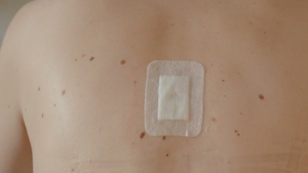 Peeling del parche en la cicatriz después de la eliminación de suturas quirúrgicas. Nevus grande ha sido extirpado quirúrgicamente con un bisturí. Medidas preventivas contra el cáncer de piel . — Vídeo de stock