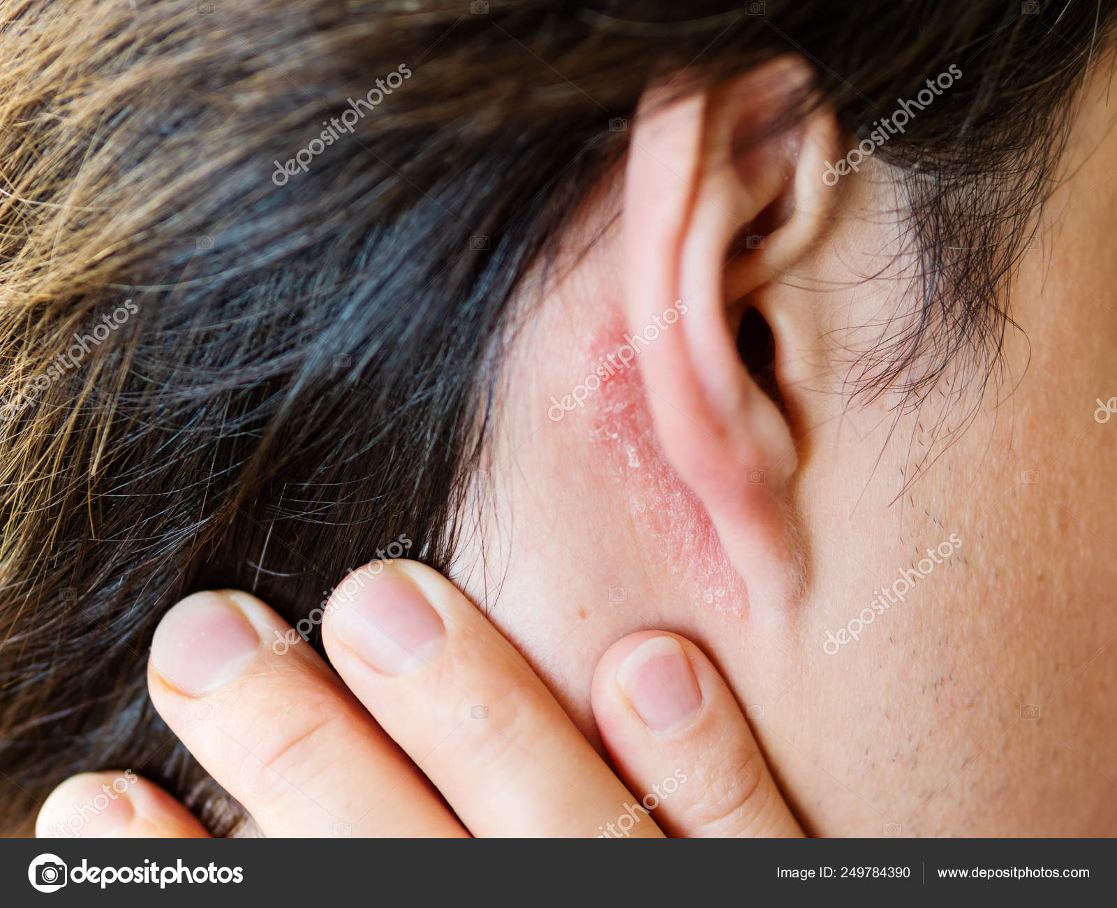 Irritation On The Skin Behind The Ear Man With Flaky Skin Allergy Or