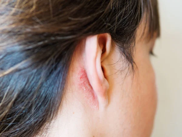 Роздратування шкіри за вухом. Людина з пласкою шкірою. Алергія або грибкові захворювання . — стокове фото