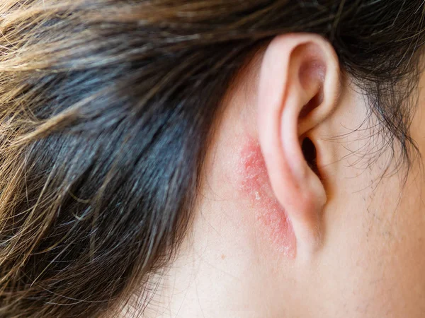 Роздратування шкіри за вухом. Людина з пласкою шкірою. Алергія або грибкові захворювання . — стокове фото