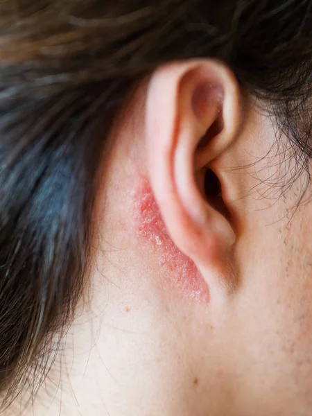Irritación en la piel detrás de la oreja. Hombre con piel escamosa . —  Fotos de Stock