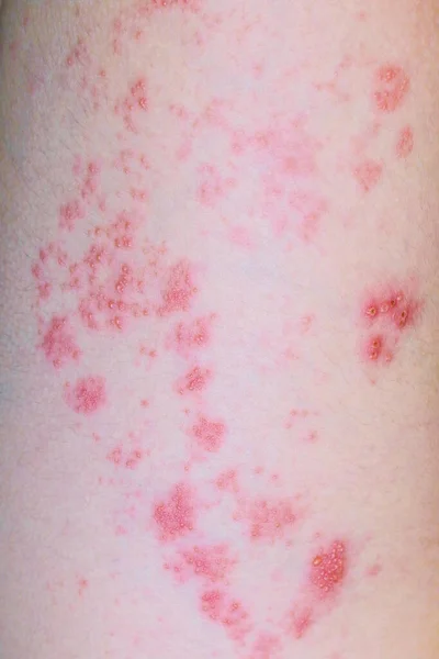 Rash Blisters Viral Disease Shingles Leg Twelve Years Old — Stock Photo, Image