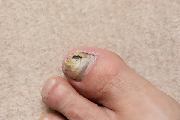 Close-up of ill male foot thumb nail, fungal nail. — Stock Photo, Image