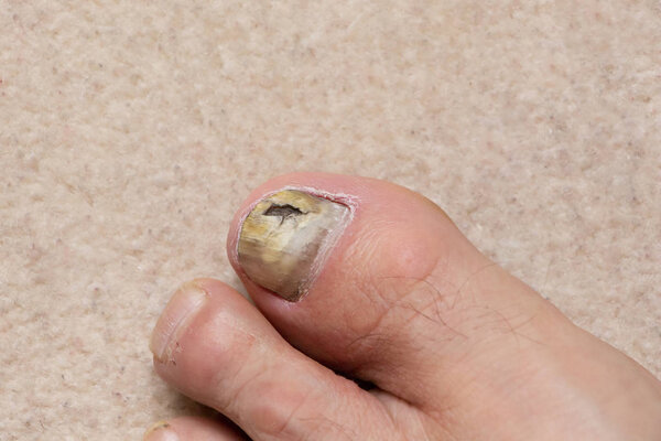 Close-up of ill male foot thumb nail, fungal nail.