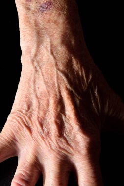 El ve el bileği yaşlı bir kadın ile bir çürük, ayrıntı