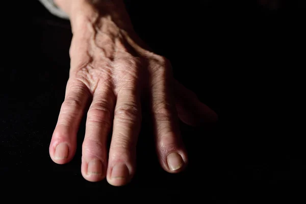 Dedo Com Reumatismo Mulher Idosa — Fotografia de Stock