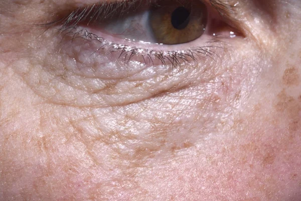 Detail van het oog zakken en rimpels van een middelbare leeftijd vrouw — Stockfoto