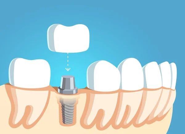 Modelo de peça de mandíbula com linha de dentes e implante dentário —  Vetores de Stock