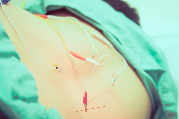 빈티지 스타일 아시아 남자의 치료를 Electroacupuncture와 뒤쪽에서 바늘에 — 스톡 사진