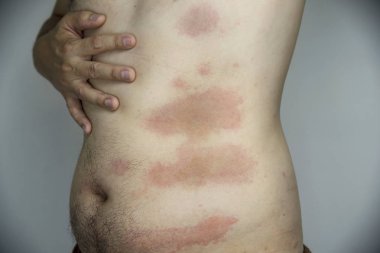 Adam vücut kısmında kırmızı deri döküntüsü alıyorum - cilt alerjisi sorunu kavramı olan insanlar