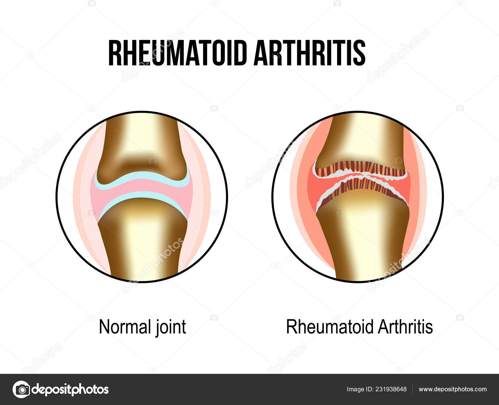 rheumatoid arthritis milyen ízületek)