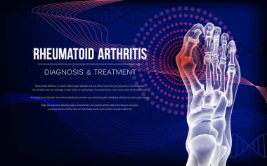 Romatoid artrit kemikleri ayak