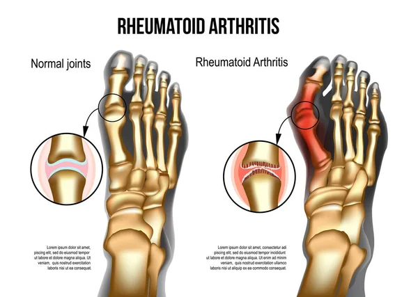 Artritis reumatoide Huesos del pie — Vector de stock