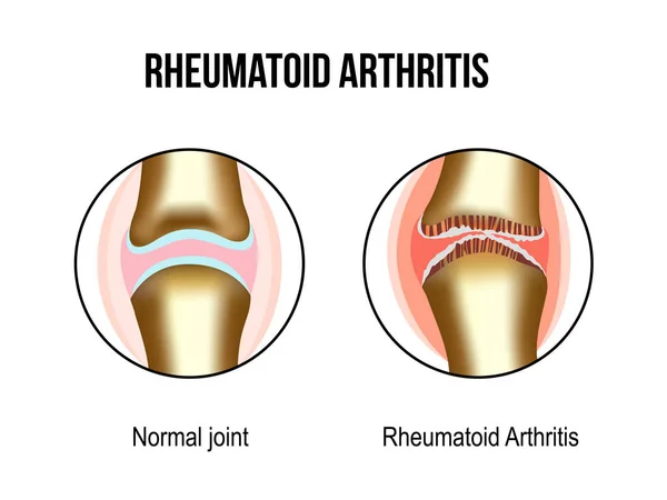 Articulaciones de artritis normal y reumatoide — Vector de stock