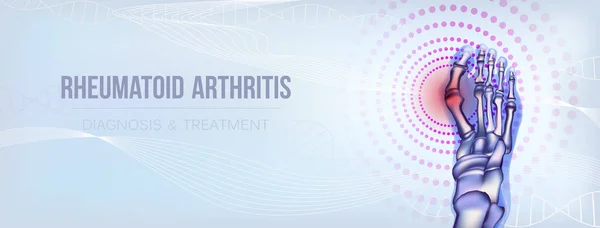 Rheumatoid arthritis bones concept — Stock Vector