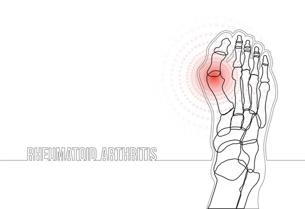 Banner de concepto de dibujo de línea continua de artritis reumatoide — Vector de stock