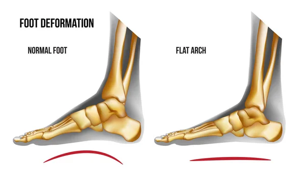 Anatomia piede piatto arco vista mediale — Vettoriale Stock