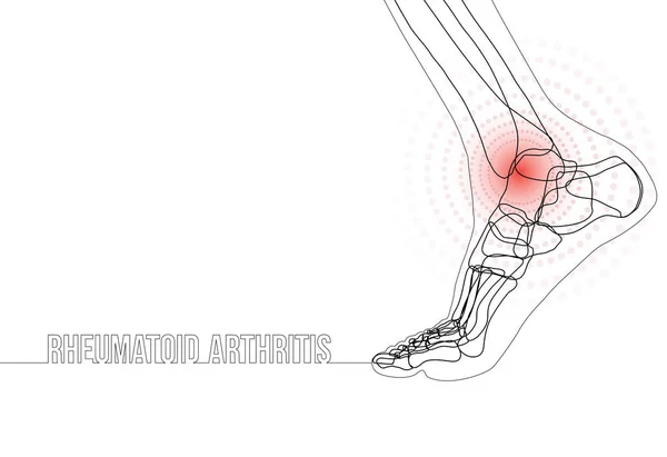 Kontinuierliche Linienzeichnung Konzept Banner über rheumatoide Arthritis — Stockvektor