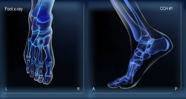 Medial et vue de dessus rayons X des os le de pied . — Image vectorielle