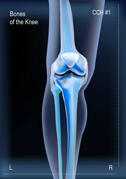 Rayos X de los huesos de la rodilla — Vector de stock