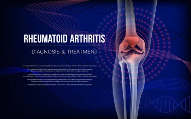 Romatoid artrit Kemikler diz