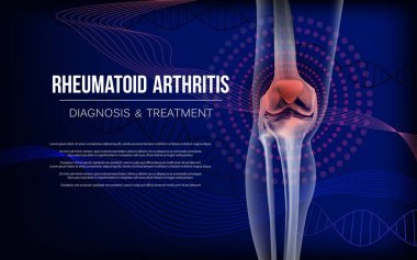 Rheumatoid arthritis Bones the of knee clipart