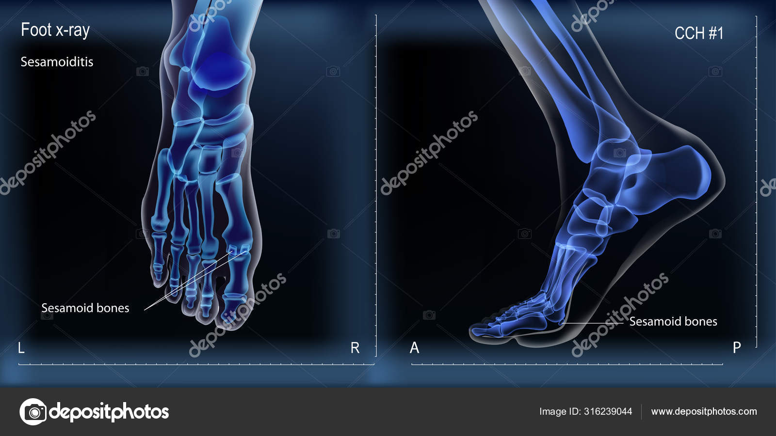 Medial and top view x ray of bones the of foot with sesamoid. Stock