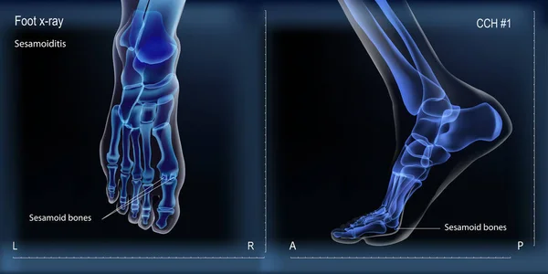 Medial et vue de dessus rayons X des os le de pied avec sésamoïde . — Image vectorielle