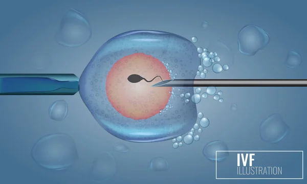 Vitro fertilizasyon enjeksiyon. Suni tohumlama. Bilimsel Tıbbi resimli vektör.