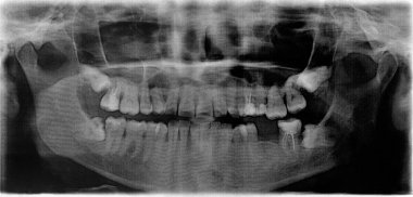 50 yaşındaki kadının ağzına 360 bakış açısı (orthopantomogram) x ray. Yirmi yaş dişleri anormal etkilenen düzenleme