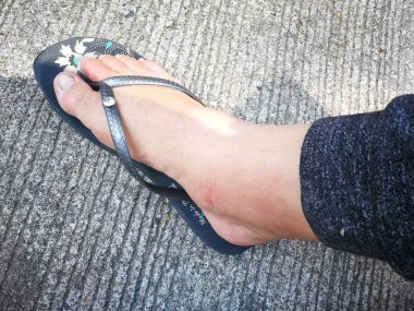 tenini yakabilecek böcek zehiri ormandan gelen hastalık