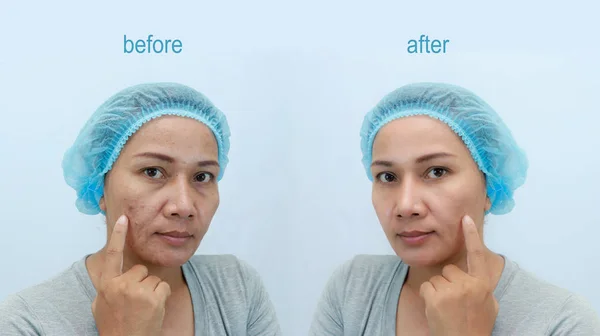 Femme Asiatique Âge Moyen Avant Après Retouche Concept Maquillage Chirurgie — Photo