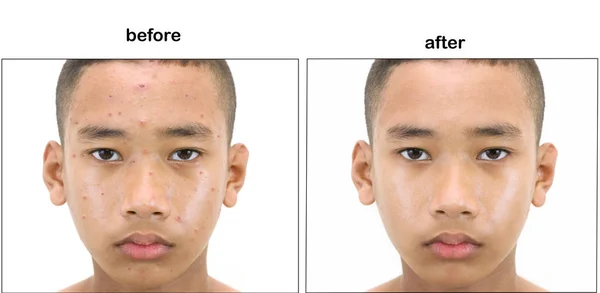 Asian Teenage Boy Retouch Concept Makeup Plastic Surgery — Stock Photo, Image