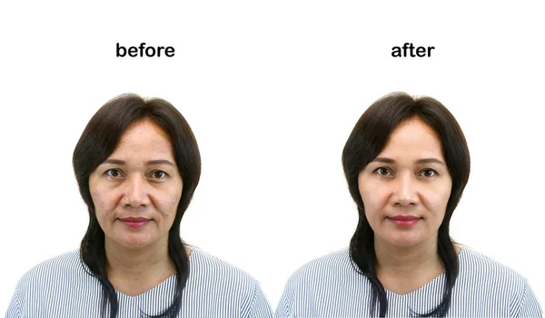 亚洲中年女人之前和之后润饰 化妆或整形外科的概念 图库照片