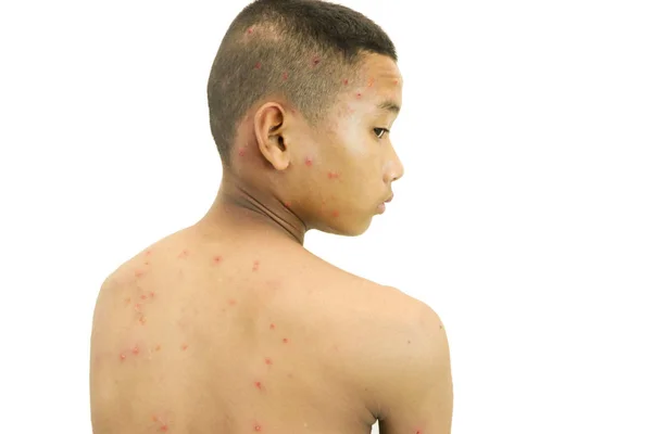 水痘带状疱疹病毒或水痘泡疹的男孩 图库图片