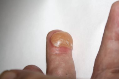 Beyaz arka plan üzerinde parmak yanıklar