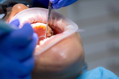 Diş muayenesi sırasında Asyalı bir kadın hasta diş hekimi randevusunda. İnsan ağzı yakından açılır. Işığı yüzüne tut. Diş hekimi ilk muayeneyi, diş temizleme ve ağız boşluğunu yapar..