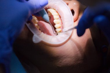 Diş muayenesi sırasında Asyalı bir kadın hasta diş hekimi randevusunda. İnsan ağzı yakından açılır. Işığı yüzüne tut. Doktor diş etlerini periodontal ölçüm sondasıyla inceliyor. Gerçek süreç.