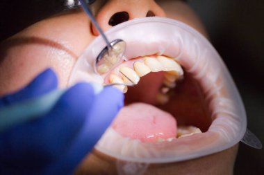 Diş muayenesi sırasında Asyalı bir kadın hasta diş hekimi randevusunda. İnsan ağzı yakından açılır. Işığı yüzüne tut. Doktor diş etlerini periodontal ölçüm sondasıyla inceliyor. Gerçek süreç.