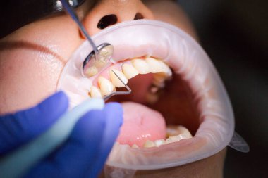 Diş muayenesi sırasında Asyalı bir kadın hasta diş hekimi randevusunda. İnsan ağzı yakından açılır. Işığı yüzüne tut. Doktor diş etlerini periodontal ölçüm sondasıyla inceliyor. Gerçek süreç.