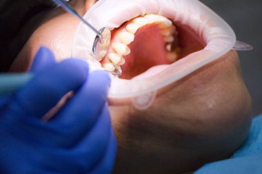 Diş muayenesi sırasında Asyalı bir kadın hasta diş hekimi randevusunda. İnsan ağzı yakından açılır. Işığı yüzüne tut. Doktor diş etlerini periodontal ölçüm sondasıyla inceliyor. Gerçek süreç.