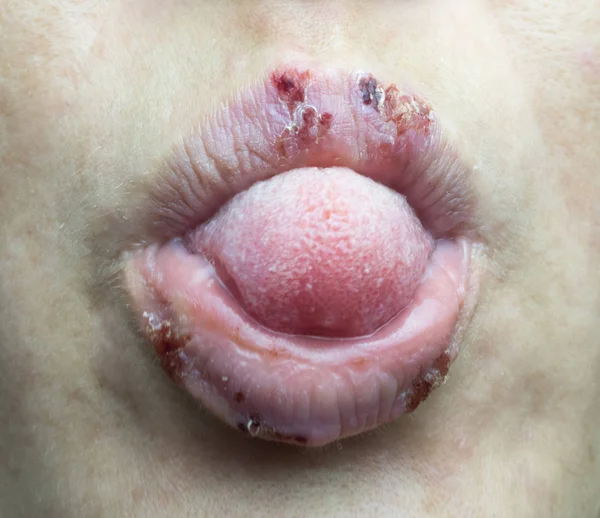 Boğazlar herpes ile kadın dudakları dil gösterir