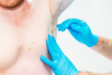 Doktor dermatolog ellerinde eldiven yakından erkek hastada klinik koltuk altı Doğum izine benzer inceliyor. İyi huylu benler kontrol. Kanser kavramı. Seçici odak. Kopya alanı