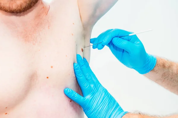 Primer Plano Dermatólogo Médico Con Las Manos Guantes Examina Marca —  Fotos de Stock