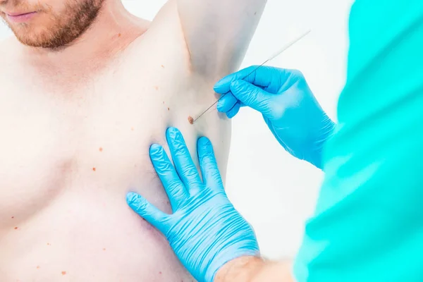 Doktor Dermatolog Ellerinde Eldiven Yakından Erkek Hastada Klinik Koltuk Altı — Stok fotoğraf